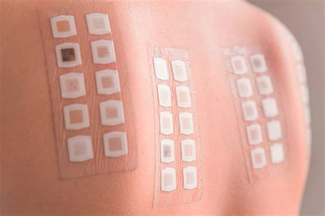 contact dermatitis patch test